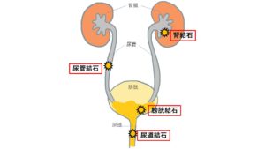 結石　閉塞部位
